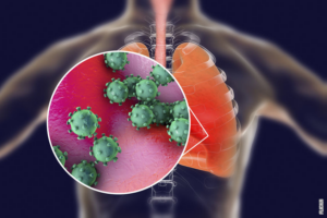 Lee más sobre el artículo ¿Qué es la bronquitis?