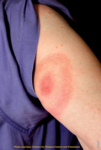 Read more about the article How is Lyme disease diagnosed and treated?