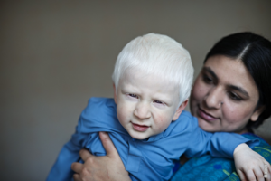 Lee más sobre el artículo ¿Qué es el albinismo?
