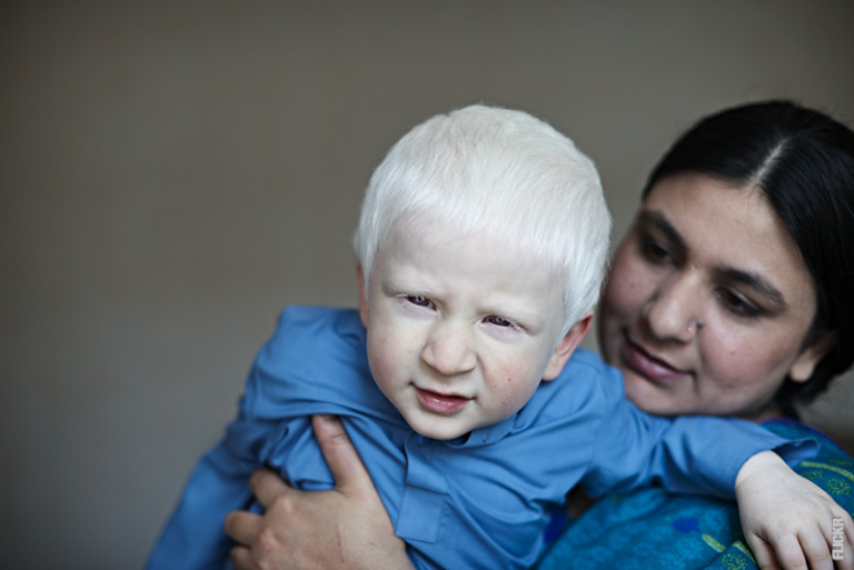 Läs mer om artikeln Vad är albinism?