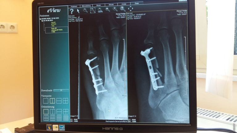 Lire la suite à propos de l’article Comment se produit la guérison d’un os fracturé?